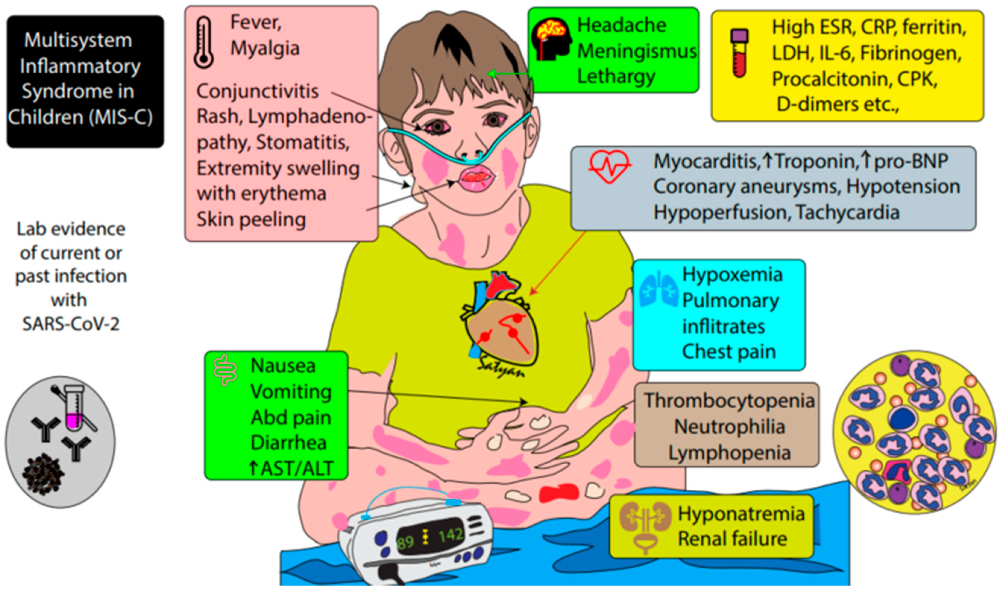 Acute Heart Failure in Multisystem Inflammatory Syndrome in