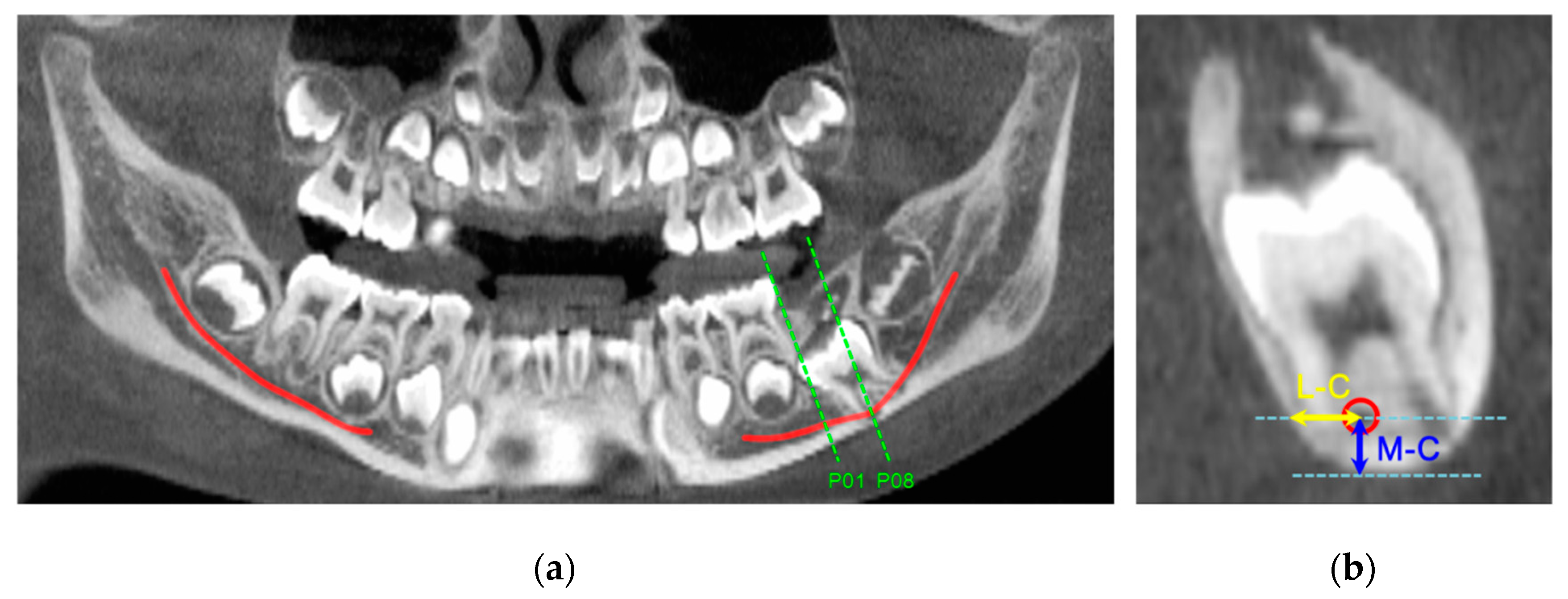 Comparison of dental anomalies between the groups with impacted