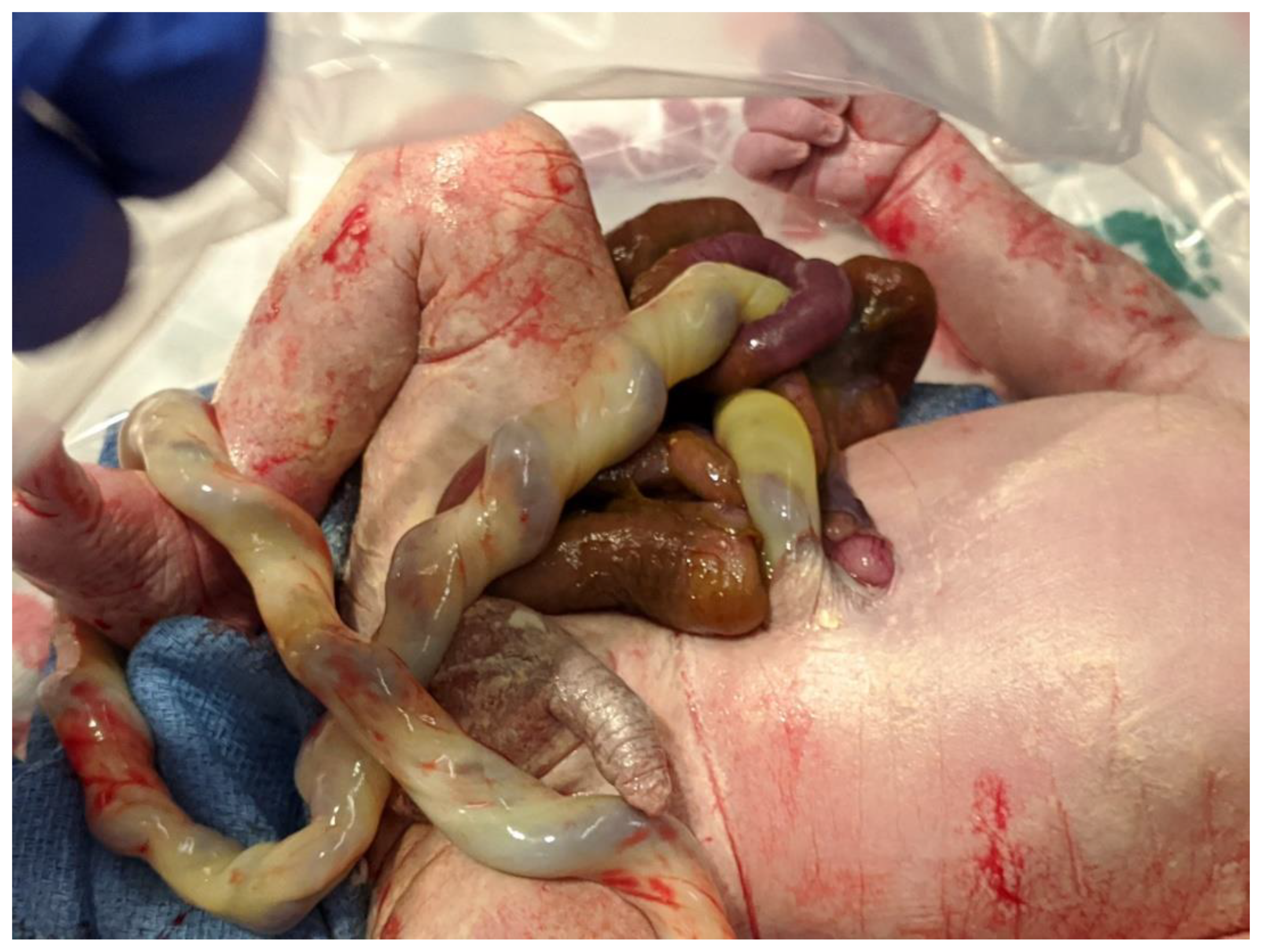 Children Free Full Text Gastroschisis A State Of The Art Review Html
