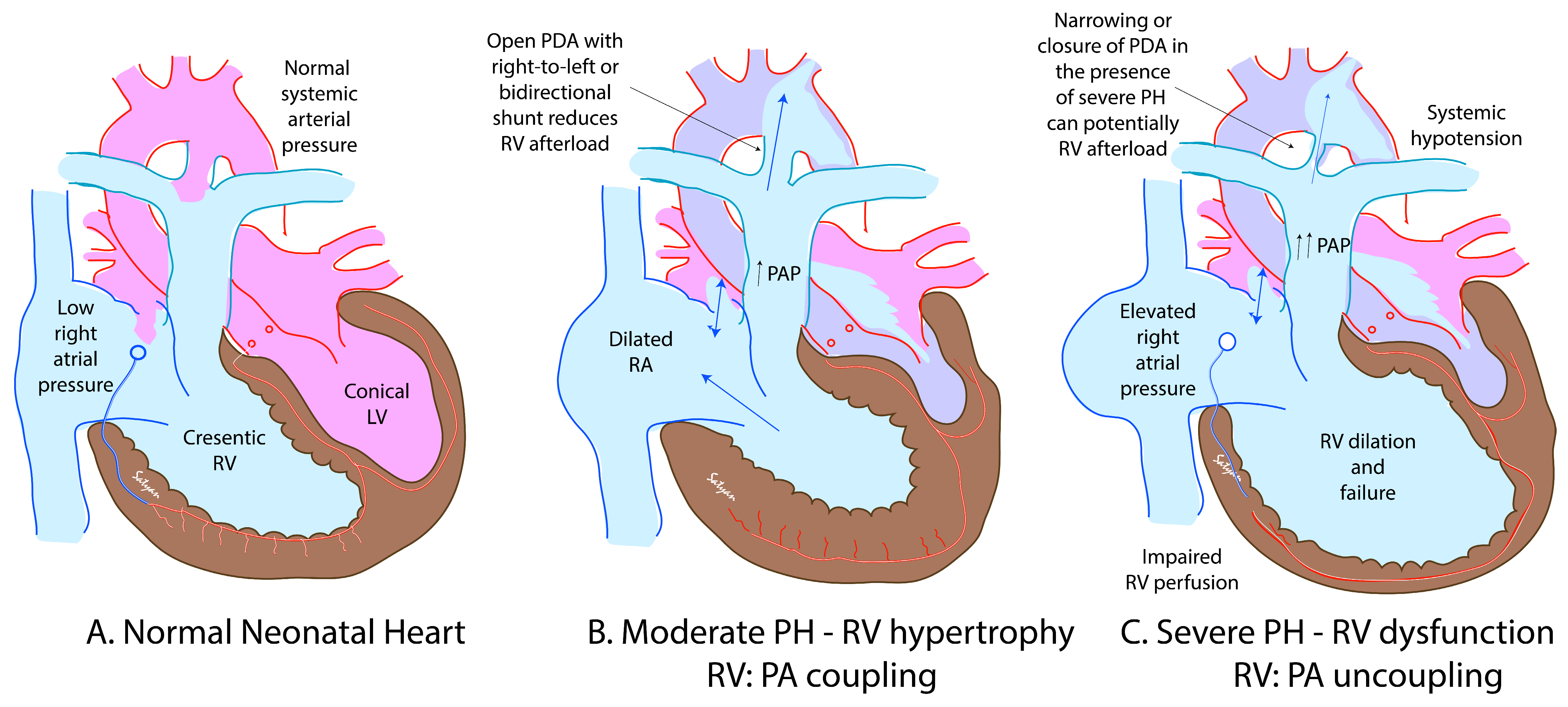 neonatal-and-postneonatal-pulmonary-hypertension