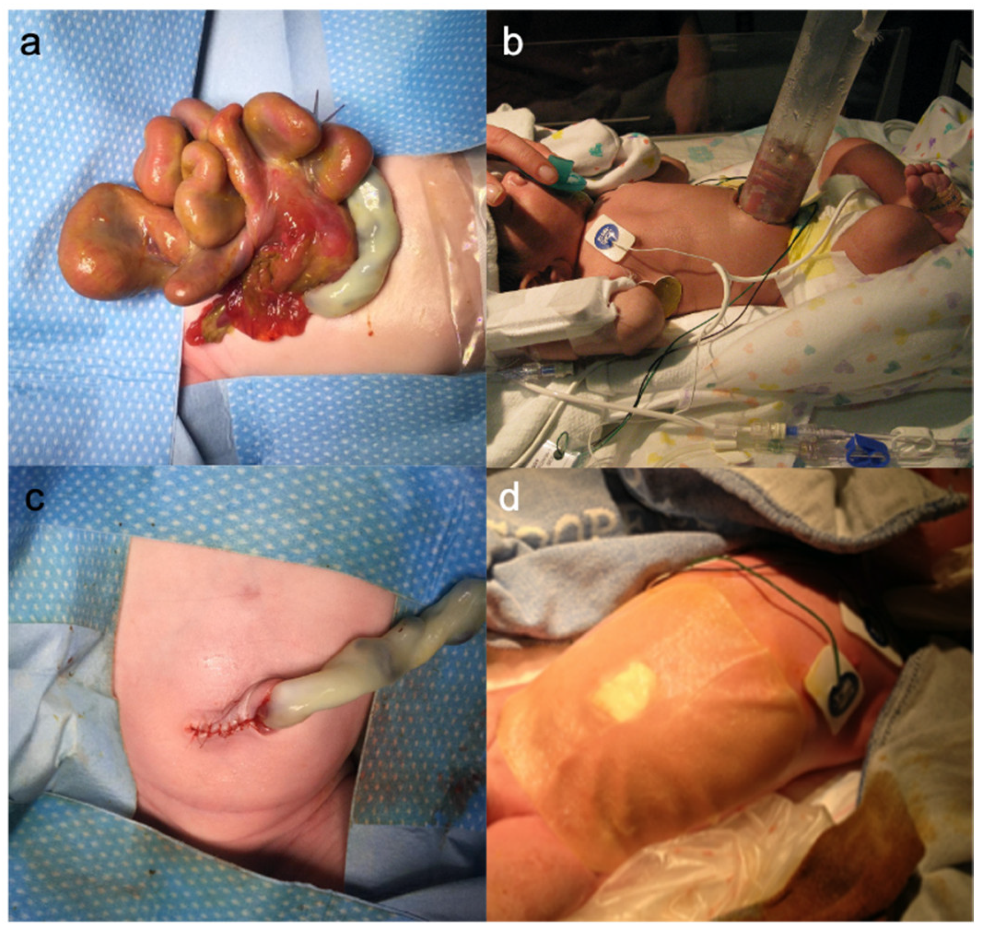 2024) Newborn's Everyday Life: Umbilical Hernia In Babies (Part 3