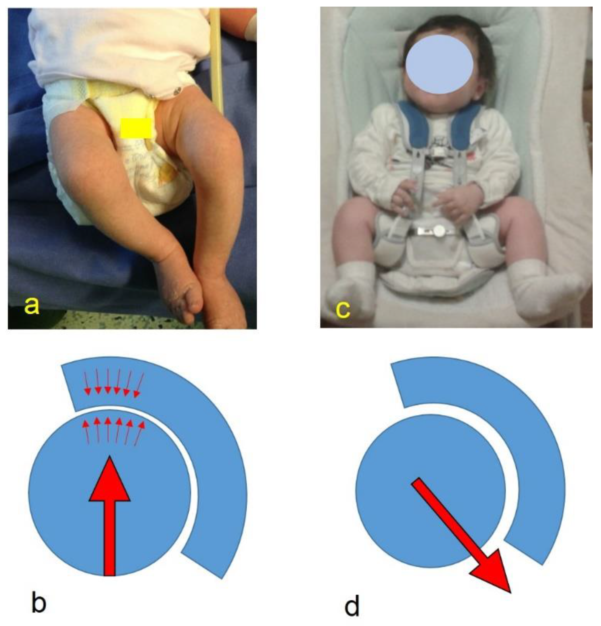 Children Free FullText Double Diapering Ineffectiveness in