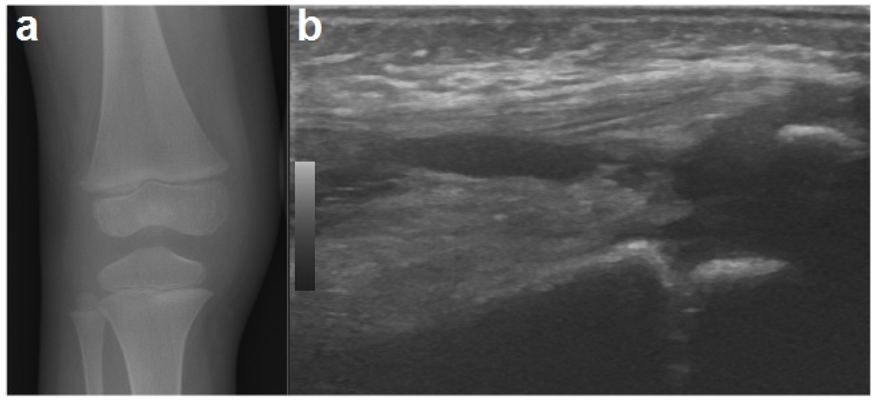 Children Free FullText Pediatric Septic Arthritis of the Knee Due to a MultiSensitive