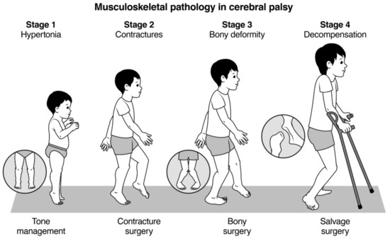 Cp Physiotherapy Treatment