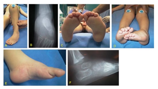 Children Free Full Text Surgical Treatment Of Clubfoot In Children With Moebius Syndrome