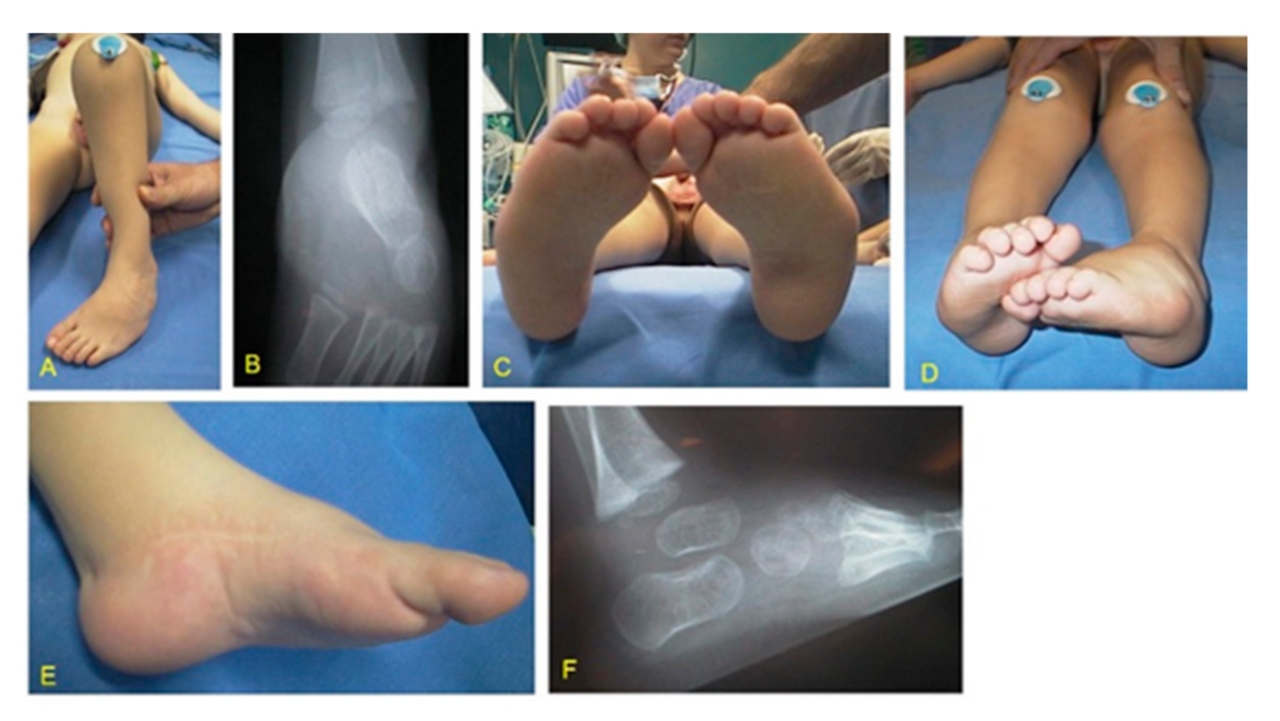 On the cure of club-foot without cutting tendons : and on certain