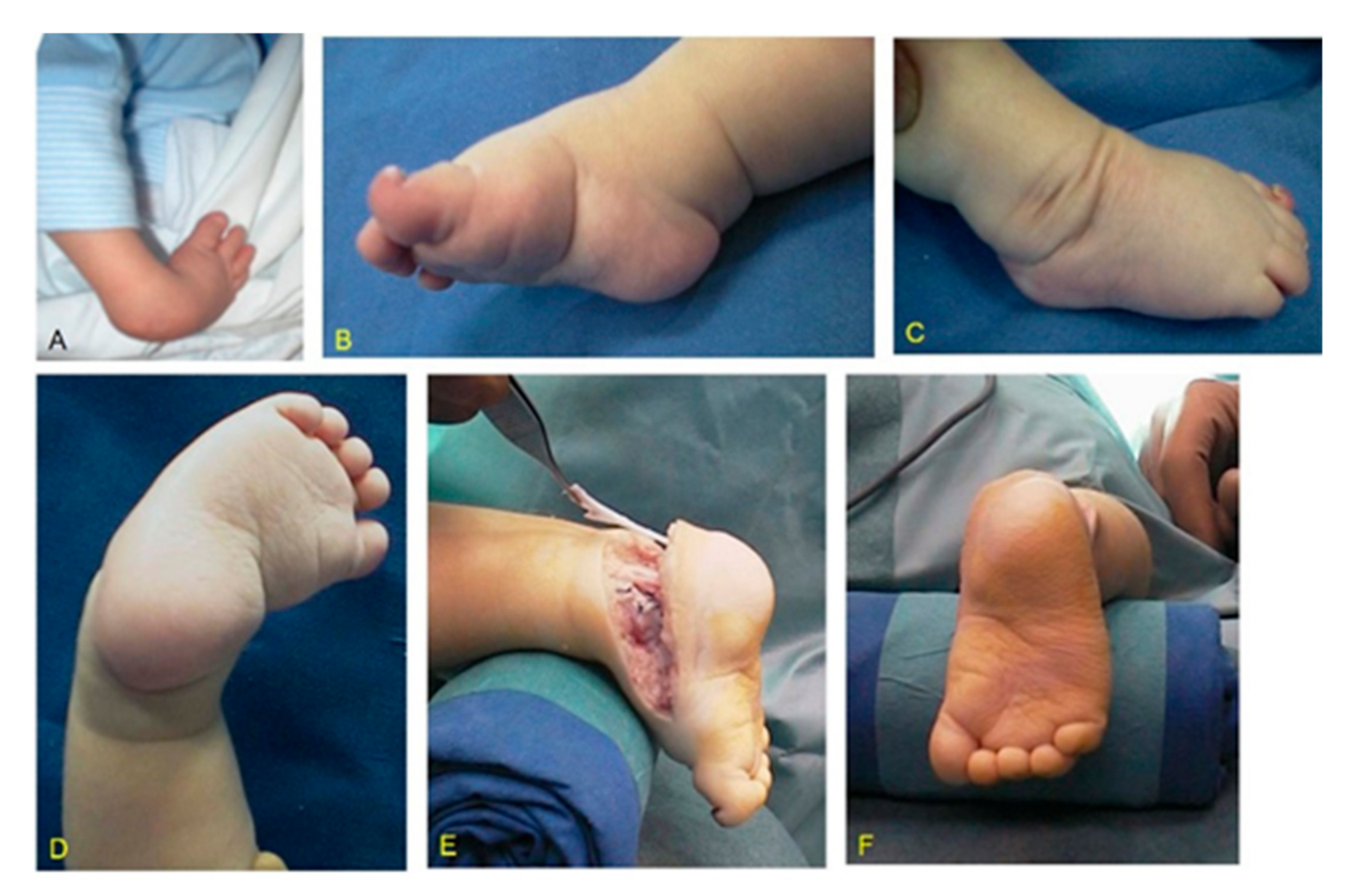 Children Free Full Text Surgical Treatment Of Clubfoot In Children With Moebius Syndrome Html