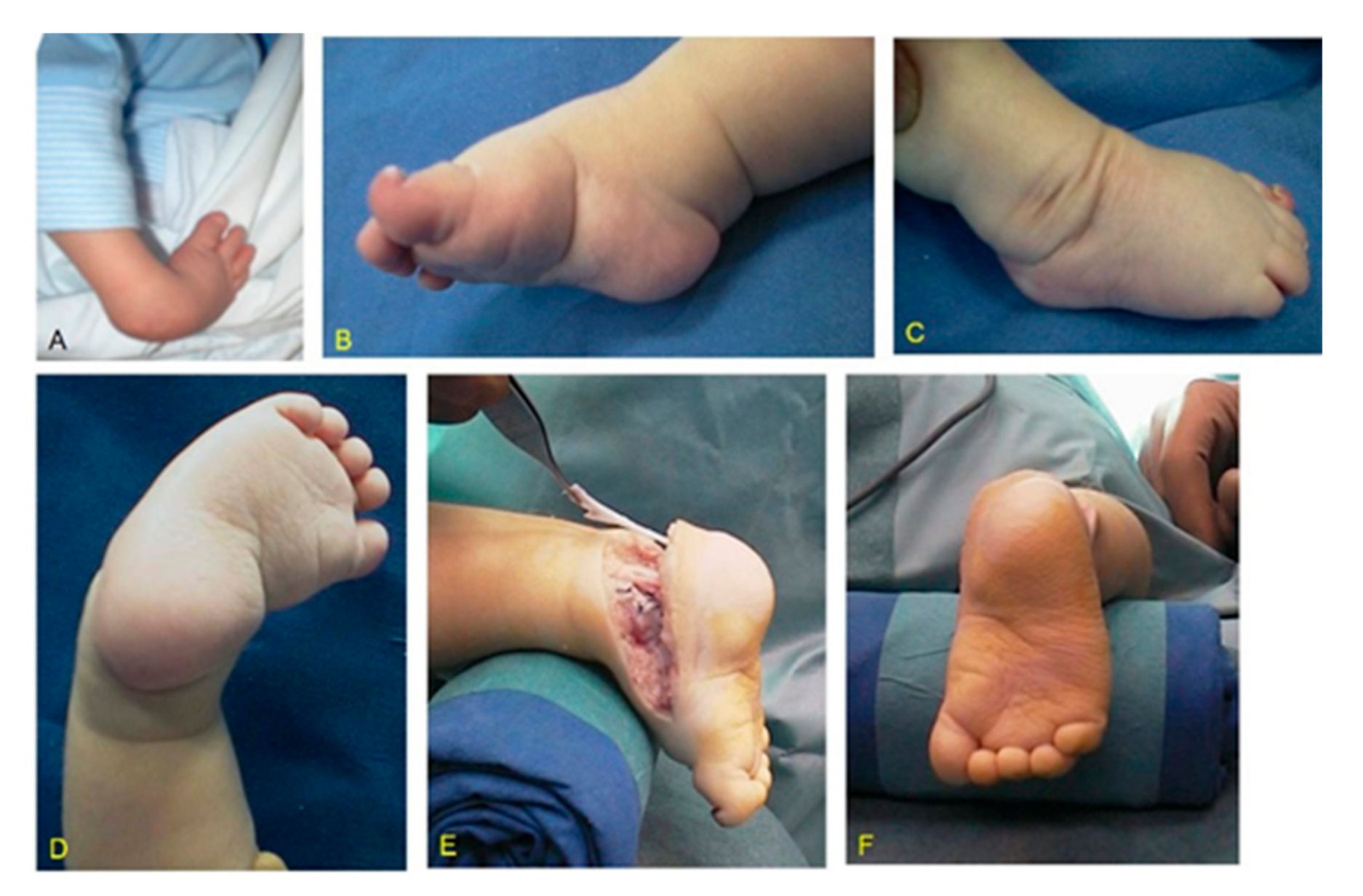 Children | Free Full-Text | Surgical Treatment of Clubfoot in Children with  Moebius Syndrome