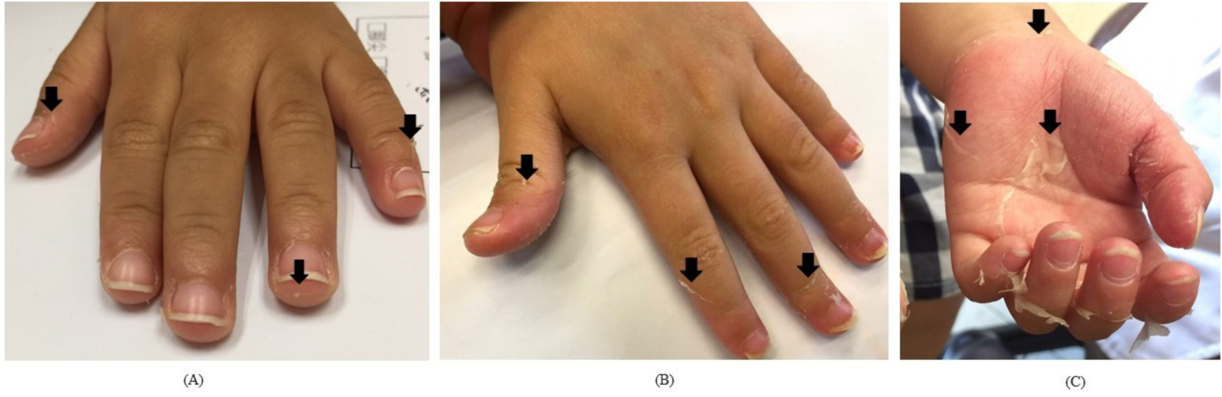 Children Free Full Text Desquamation in Kawasaki Disease