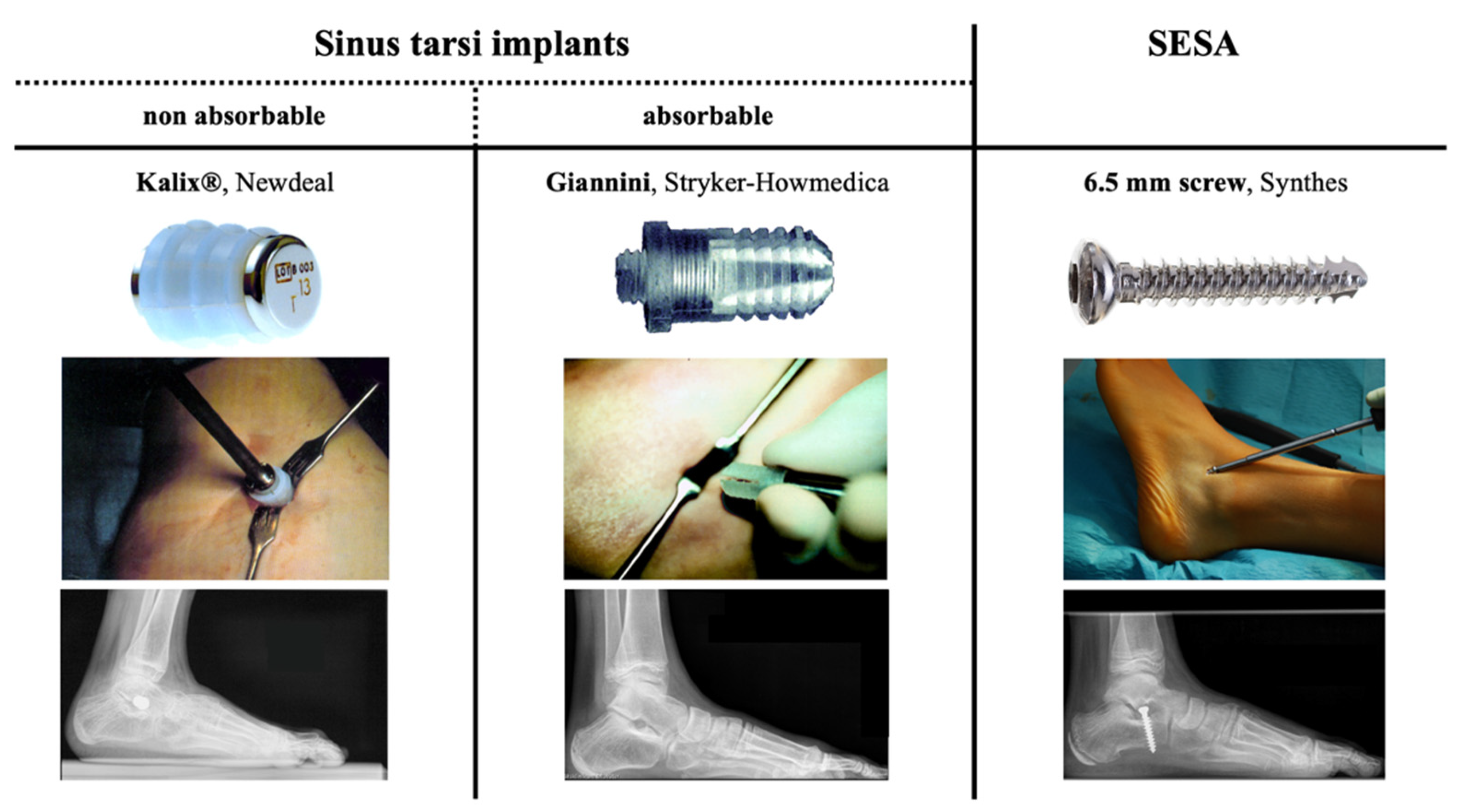 Subtalar Fusion Surgery: The Ultimate Picture Guide - 3v16prq