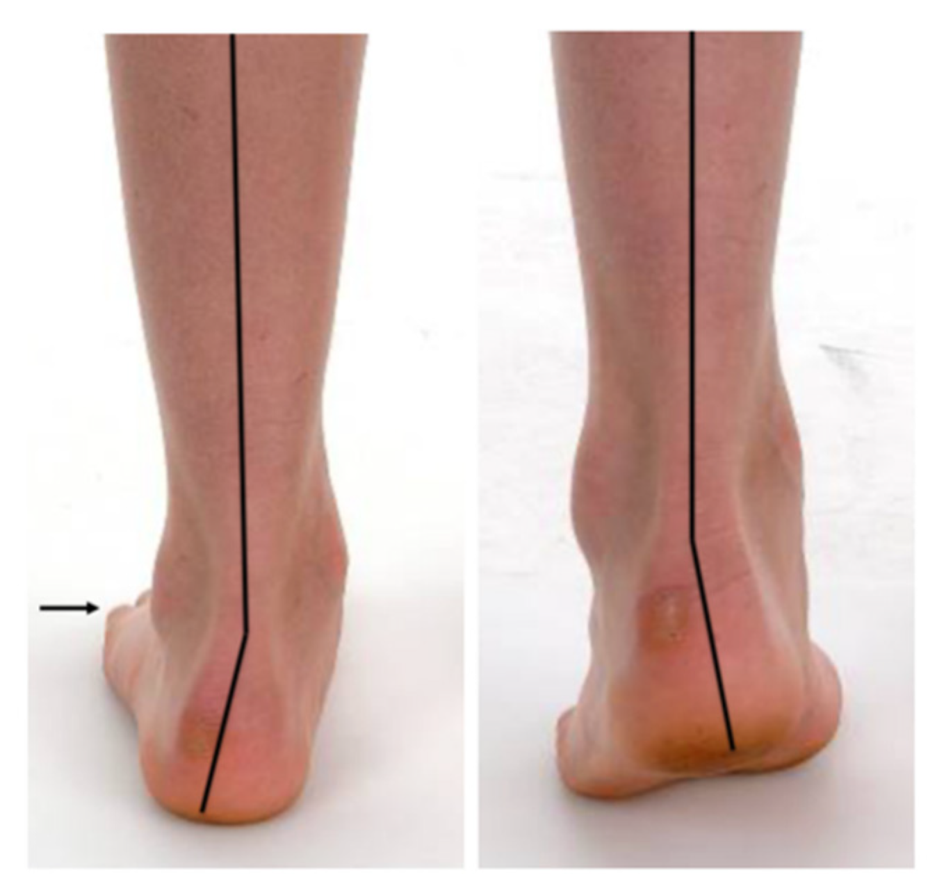 Children Free FullText Subtalar Arthroereisis for Flexible