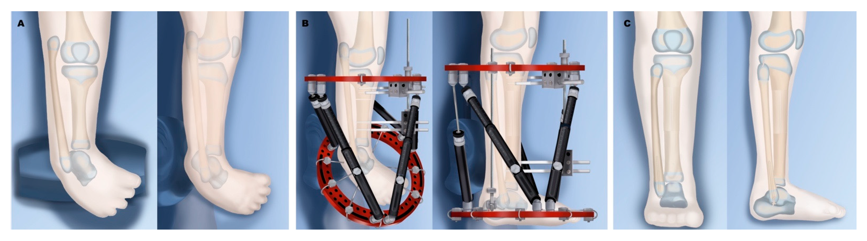 A CASE OF UNILATERAL TIBIAL HEMIMELIA WITH UNILATERAL RADIAL CLUB