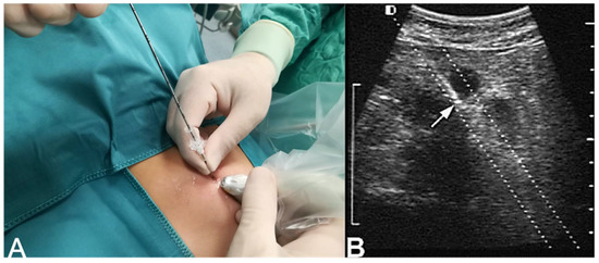 Real-time MR-guided brain biopsy using 1.0-T open MRI