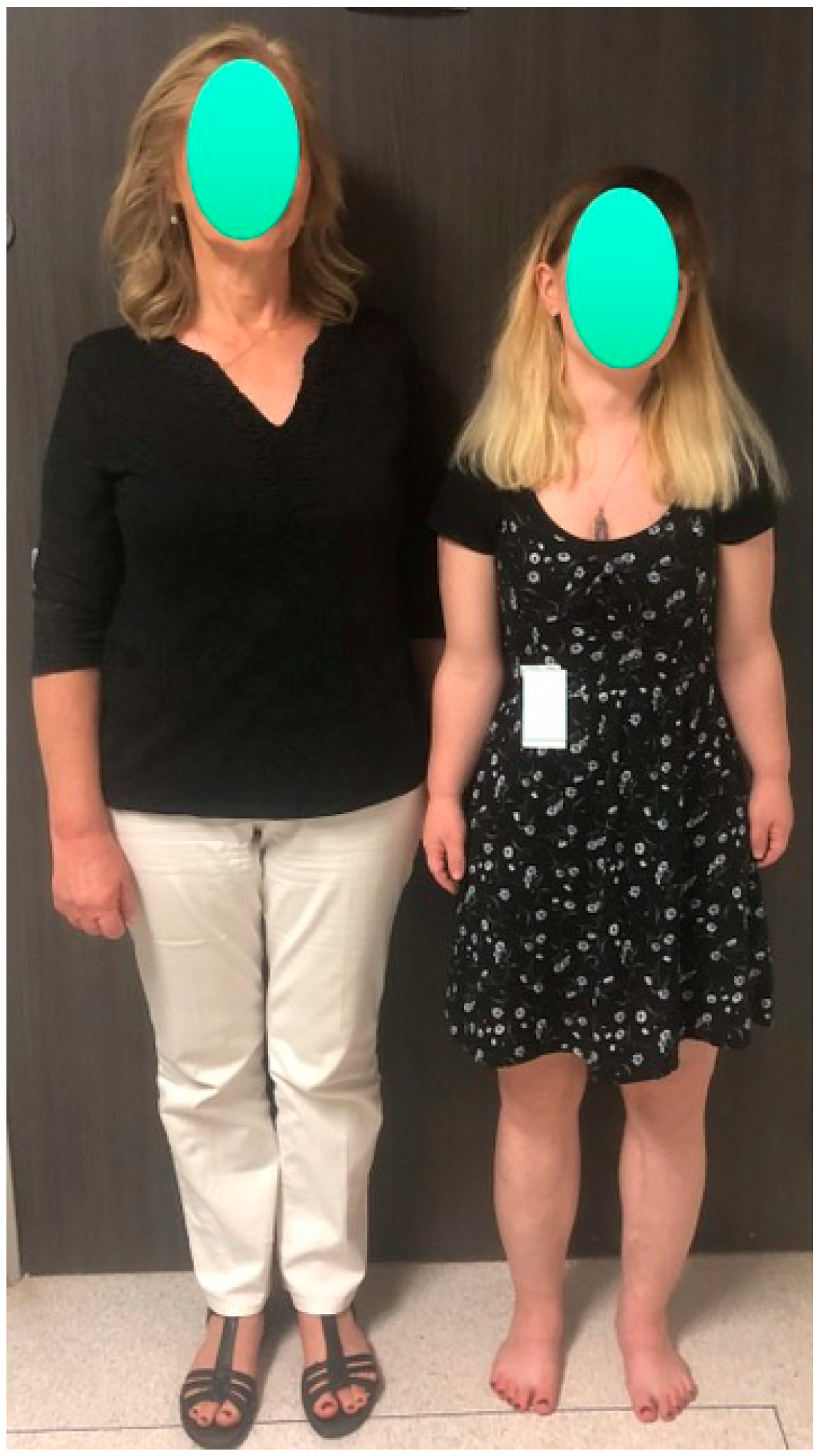 Hypochondroplasia Dwarfism