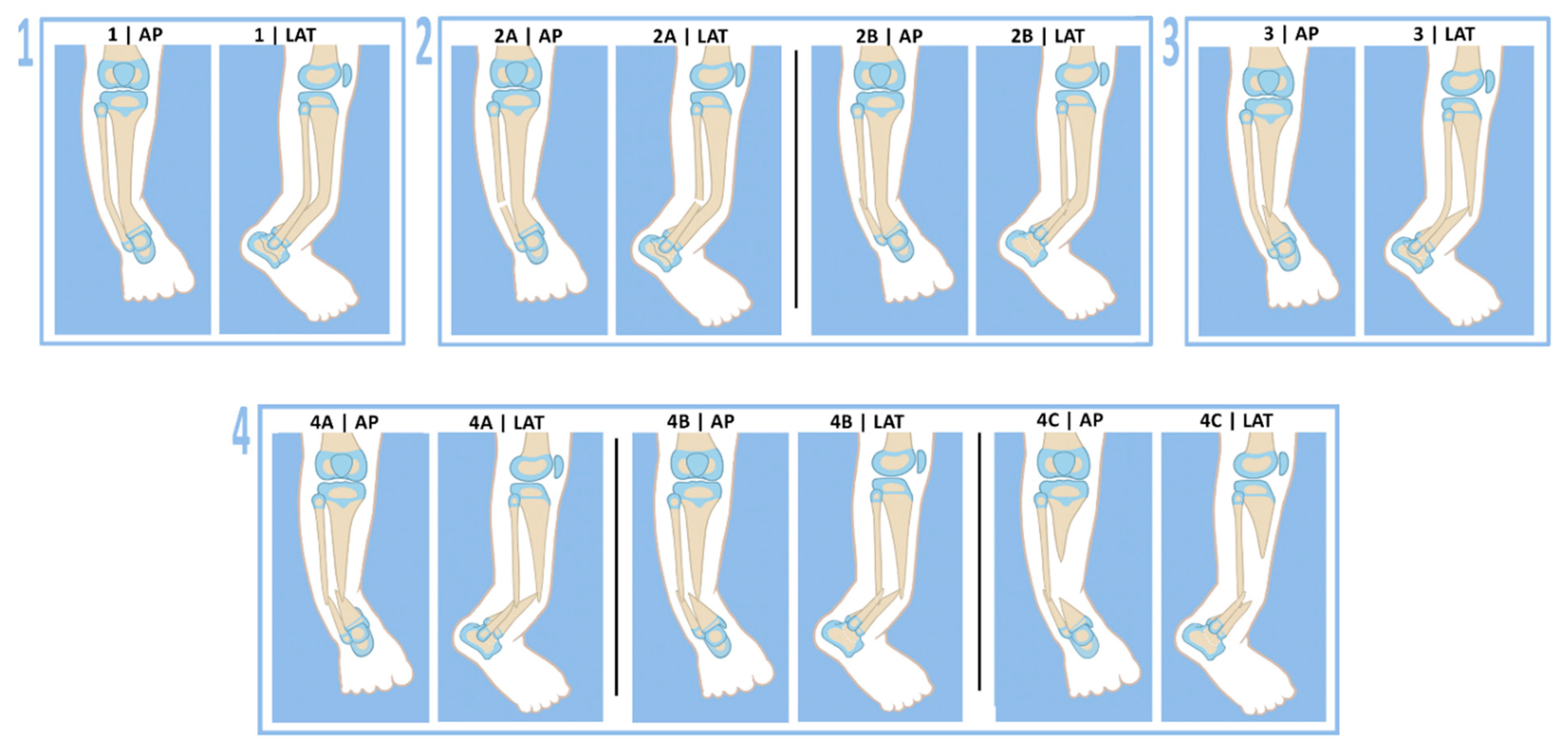 Children Free Full Text Cross Union Surgery For Congenital Pseudarthrosis Of The Tibia Html