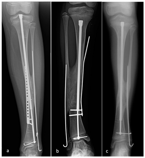大腿骨近位部骨折 Osteosynthesis & Arthroplasty 大腿骨近位部骨折の治療｜整形外科｜千船病院【大阪市】