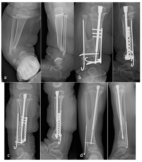 大腿骨近位部骨折 Osteosynthesis & Arthroplasty Cross-Union Surgery for Congenital Pseudarthrosis of the Tibia