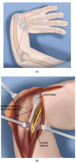 Ulnar Longitudinal Deficiency (Ulnar Club Hand)