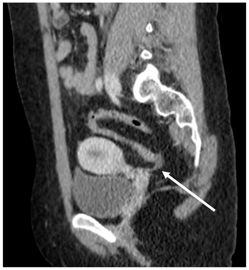 Children Free FullText Segmental Absence of Intestinal Musculature