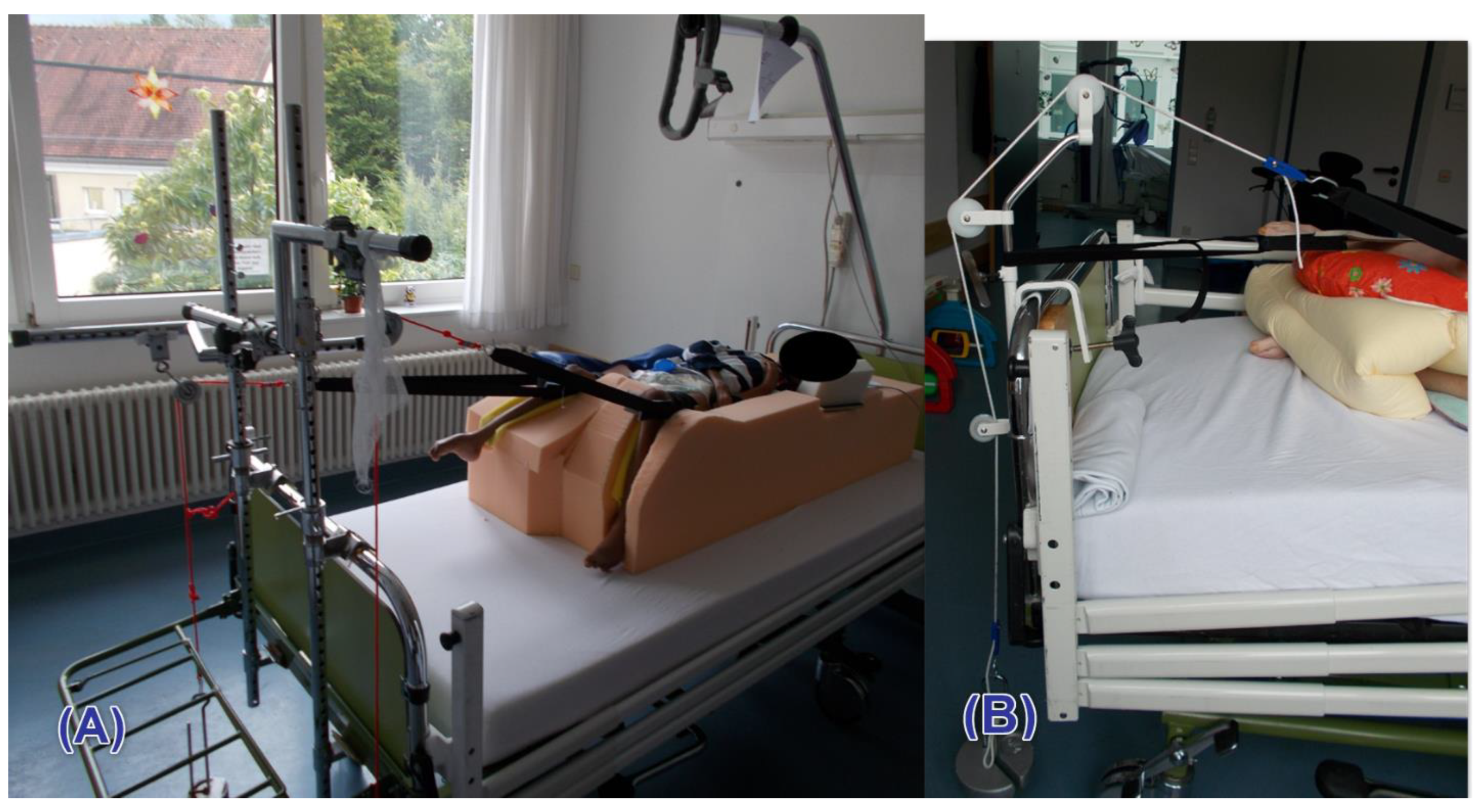 Radiological Outcomes of Femoral Head Resection in Patients