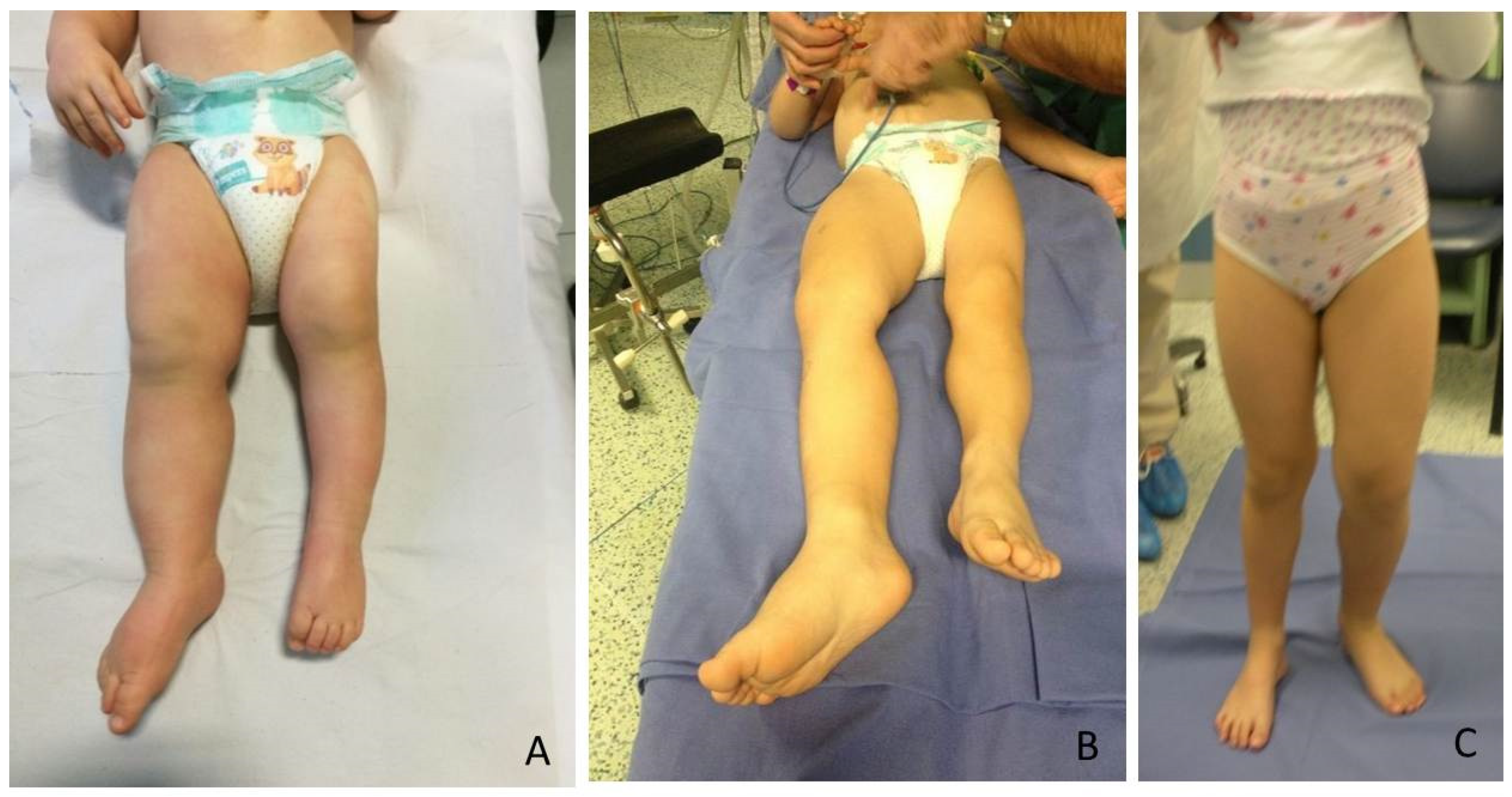 Guided Growth in Leg Length Discrepancy in BeckwithWiedemann Syndrome A Consecutive Case Series