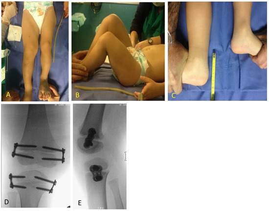 Guided Growth in Leg Length Discrepancy in Beckwith Guided Growth in Leg Length Discrepancy in Beckwith