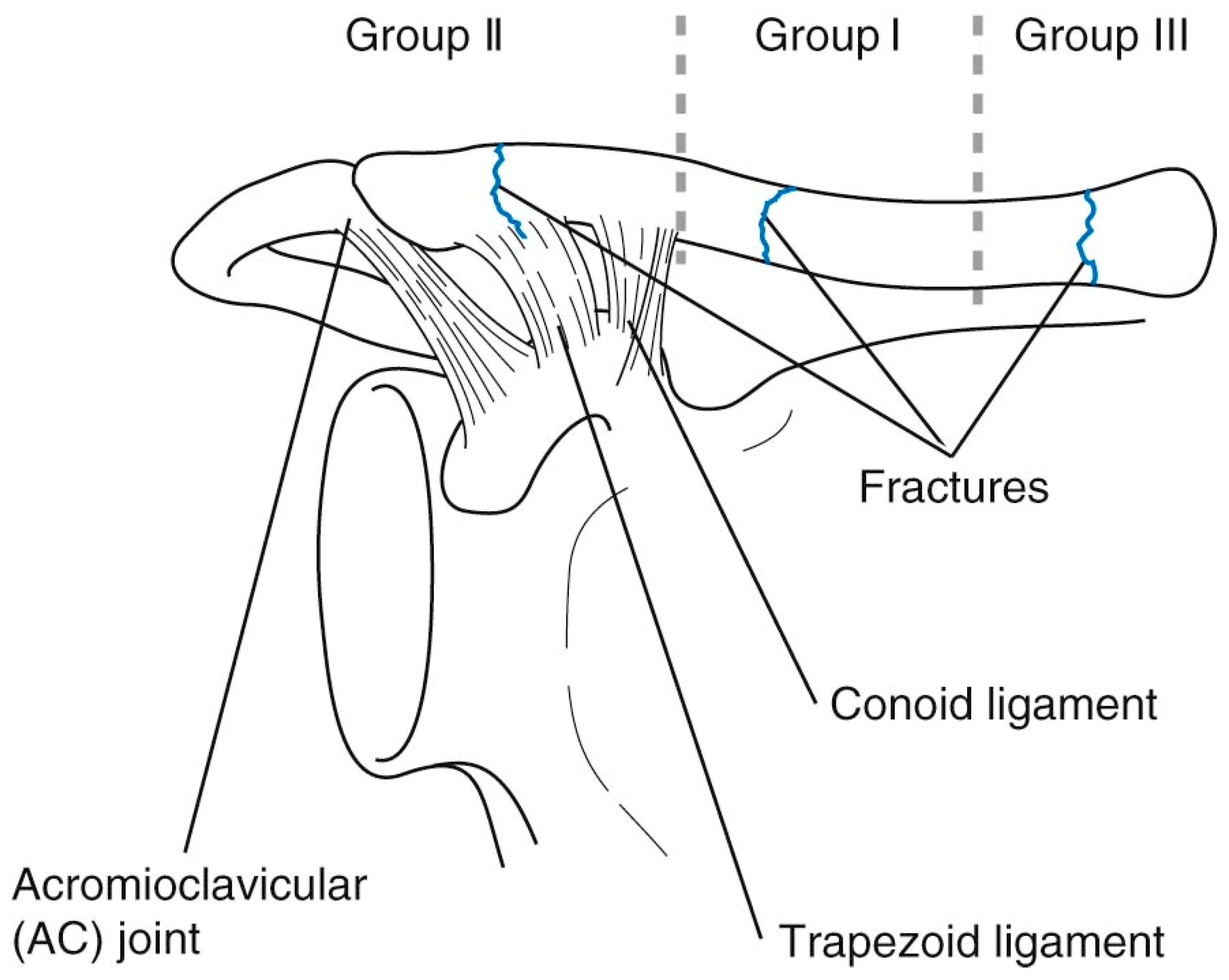 Children Free Full Text Pediatric Clavicle Fractures And Congenital