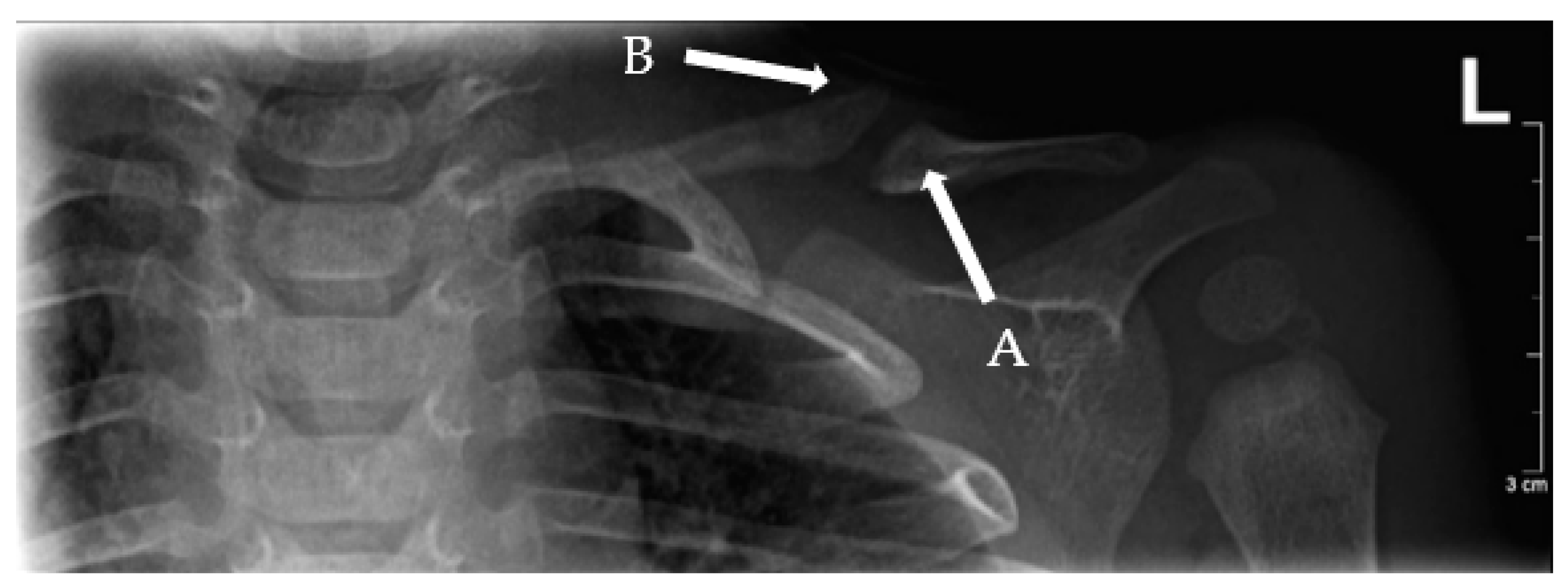 Children Free Full Text Pediatric Clavicle Fractures And Congenital