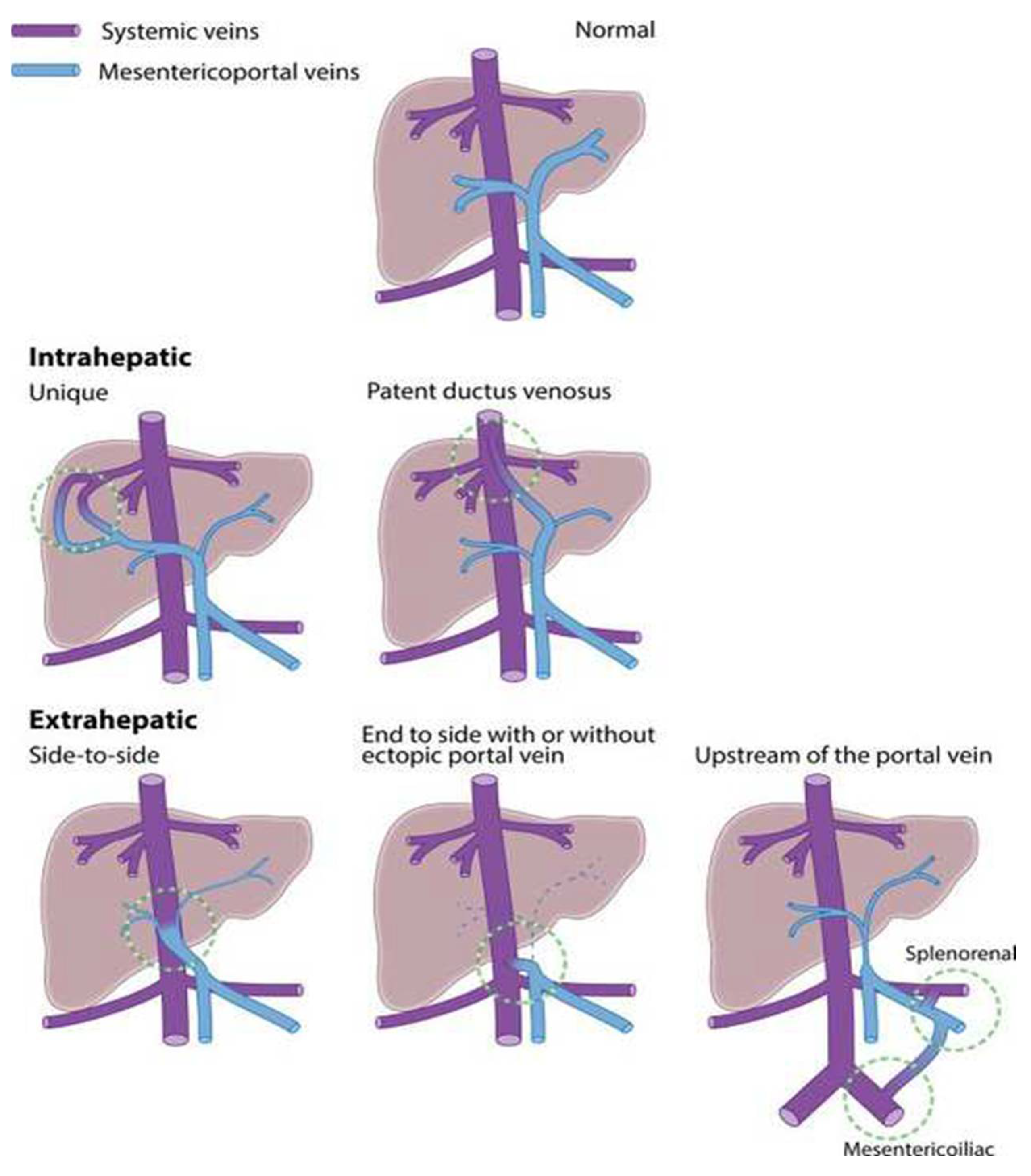 Children | Free Full-Text | Presentation of Congenital Portosystemic Shunts  in Children