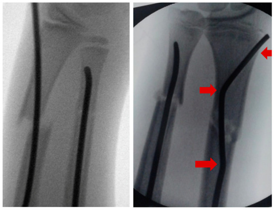 PDF] Pediatric Forearm Refracture with Intramedullary Nail Bending In Situ:  Options for Treatment | Semantic Scholar