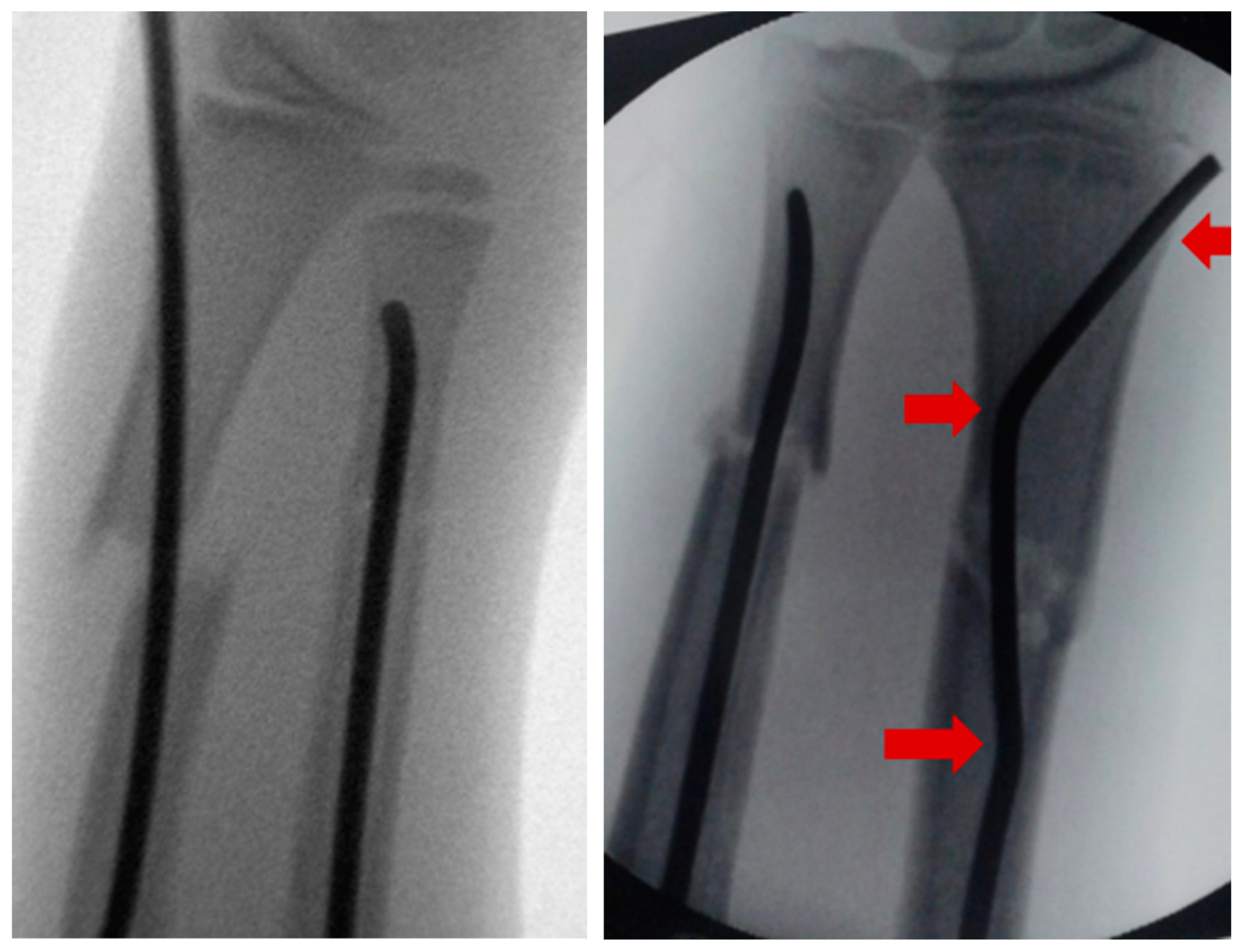 Frontiers | Elastic Stable Intramedullary Nailing and Temporary External  Fixation for the Treatment of Unstable Femoral Shaft Fractures in Children  Aged 5-11 Years Old: A Retrospective Study of 28 Cases
