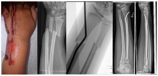 Nailing of diaphyseal ulna fractures in adults—biomechanical evaluation of  a novel implant in comparison with locked plating | Journal of Orthopaedic  Surgery and Research | Full Text
