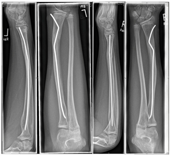 a Immediate postoperative and 4 weeks postoperative radiographs of a... |  Download Scientific Diagram