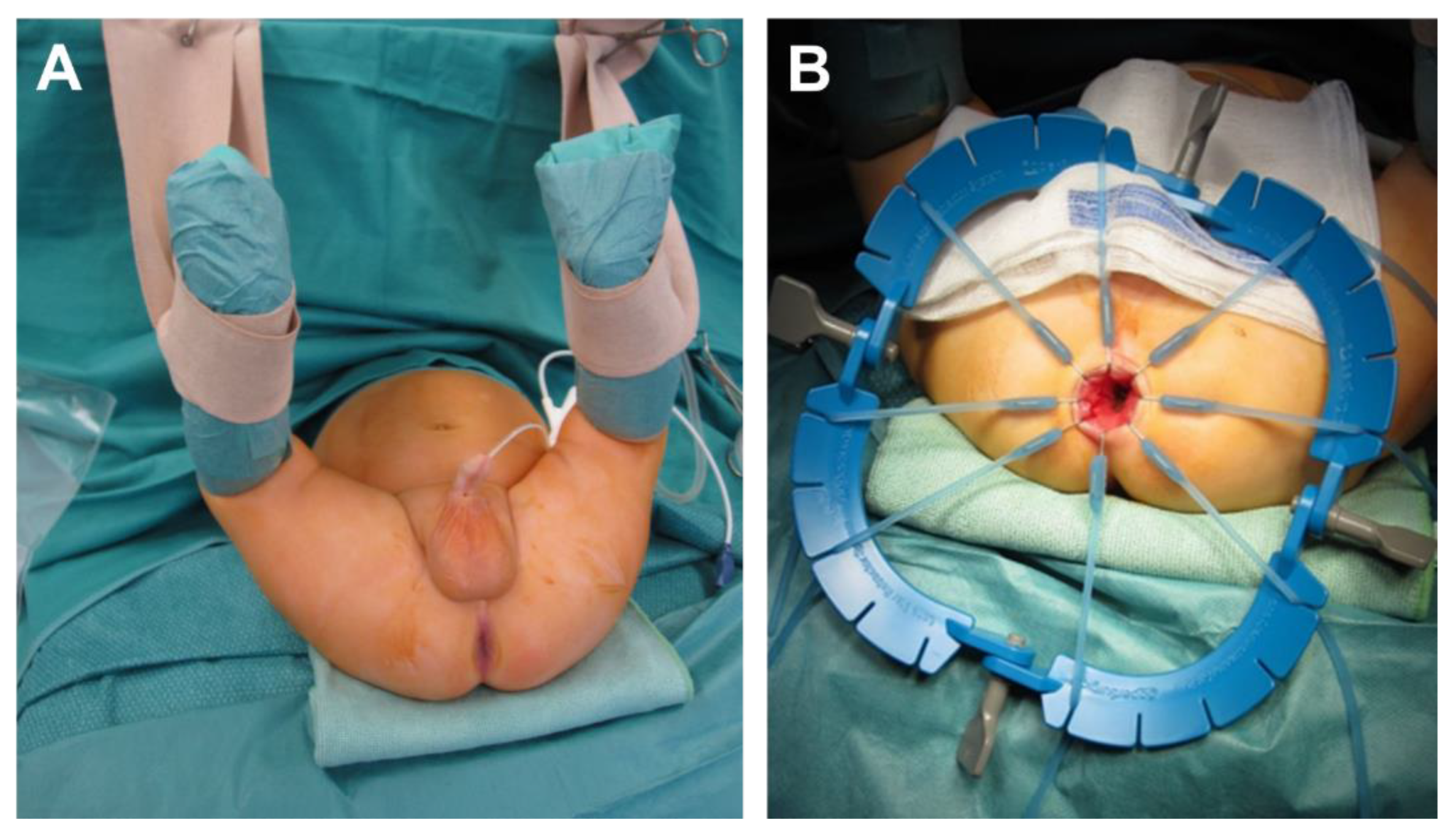 Case 52-1991 — An Eight-Year-Old Girl with Recurrent Abdominal Distention  after Surgical Correction of Hirschsprung's Disease