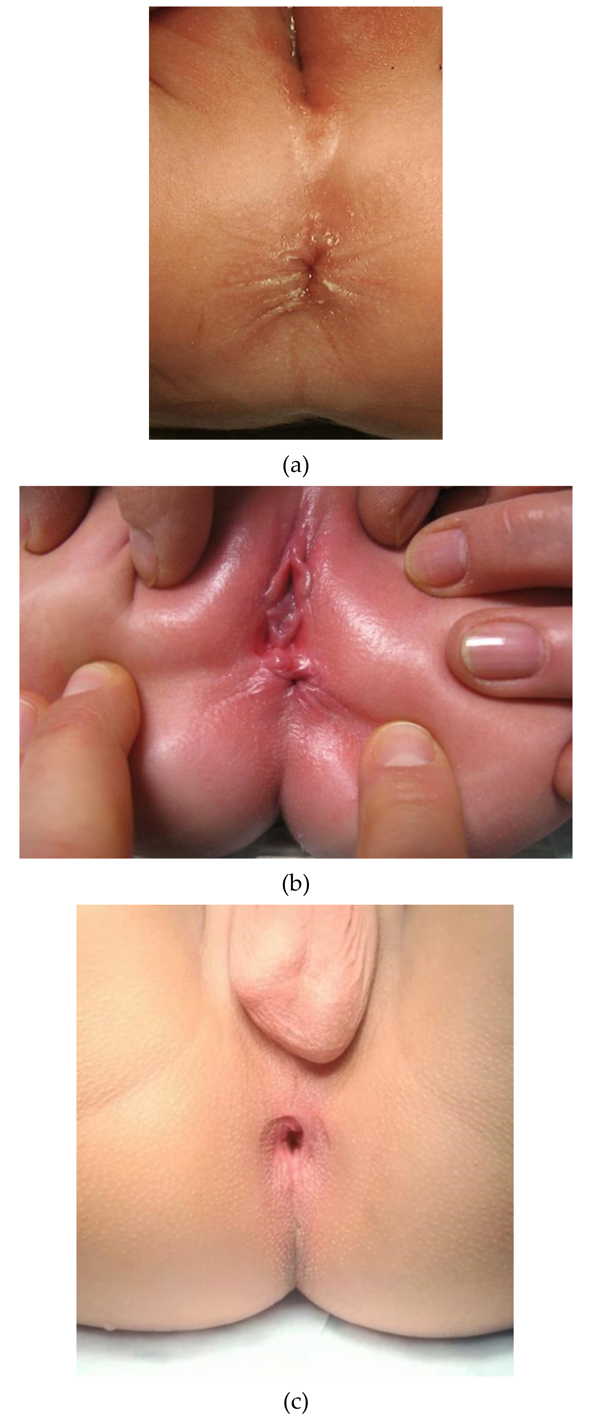 Children Free Full-Text Clinical Differentiation between a Normal Anus, Anterior Anus, Congenital Anal Stenosis, and Perineal Fistula Definitions and Consequencesandmdash;The ARM-Net Consortium Consensus Adult Pic Hq