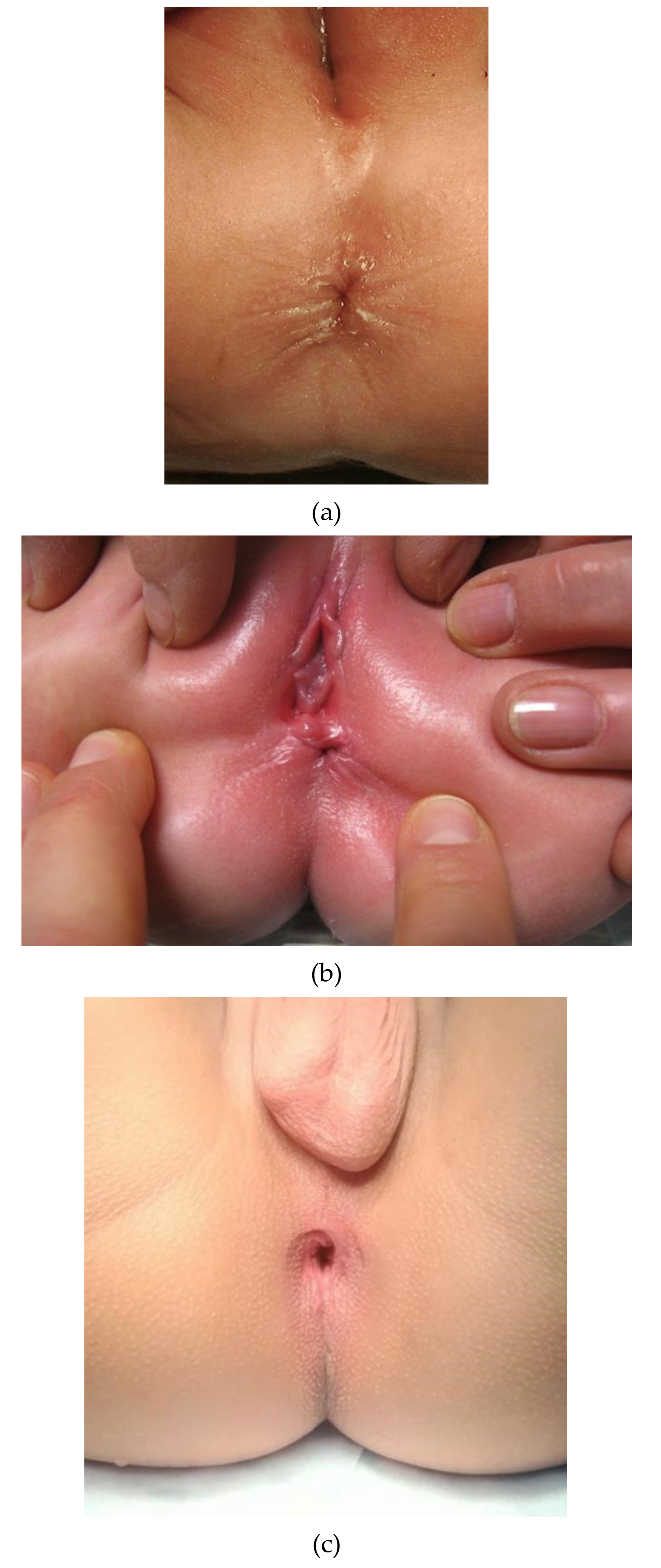 Children | Free Full-Text | Clinical Differentiation between a Normal Anus,  Anterior Anus, Congenital Anal Stenosis, and Perineal Fistula: Definitions  and Consequences—The ARM-Net Consortium Consensus