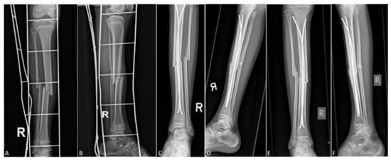 Intramedullary nail fixation for tibial and fibular fractures | Radiology  Case | Radiopaedia.org