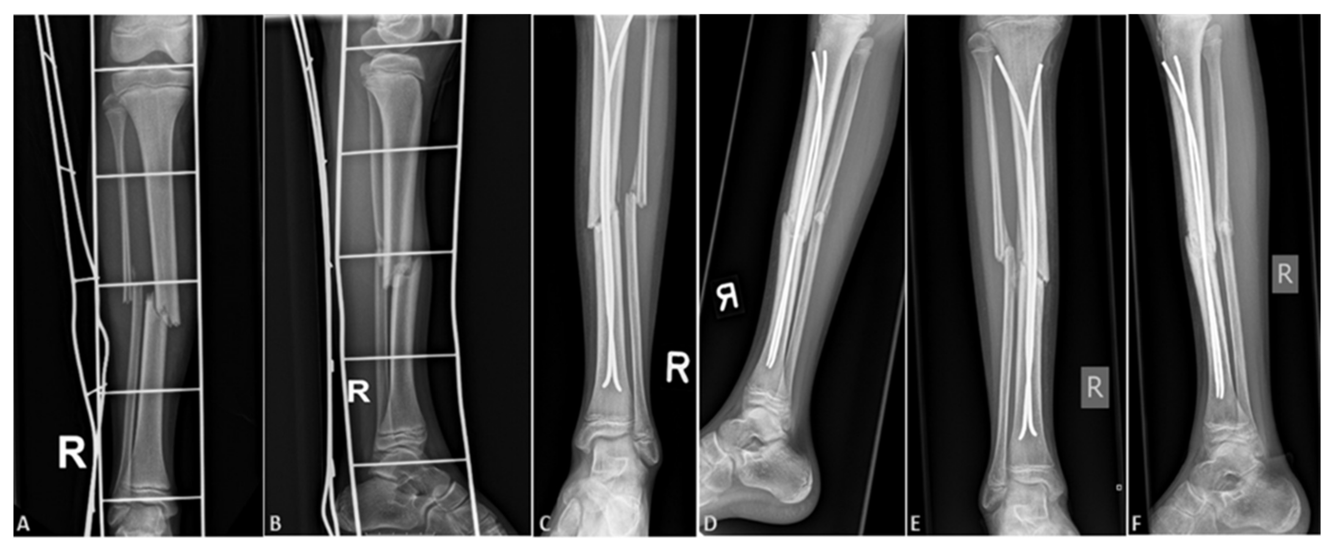 A Review of Proximal Tibia Entry Points for Intramedullary Nailing