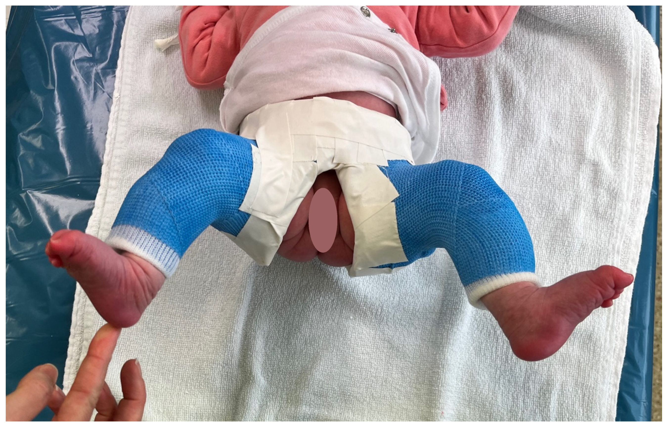 Children | Free Full-Text | Outcome Prognostic Factors in MRI during Spica  Cast Therapy Treating Developmental Hip Dysplasia with Midterm Follow-Up