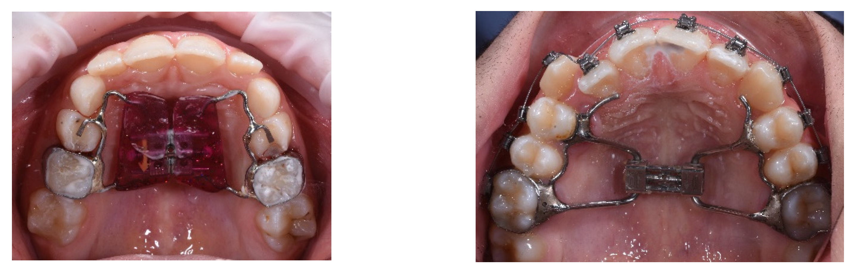 hyrax-appliance-rapid-maxillary-expansion