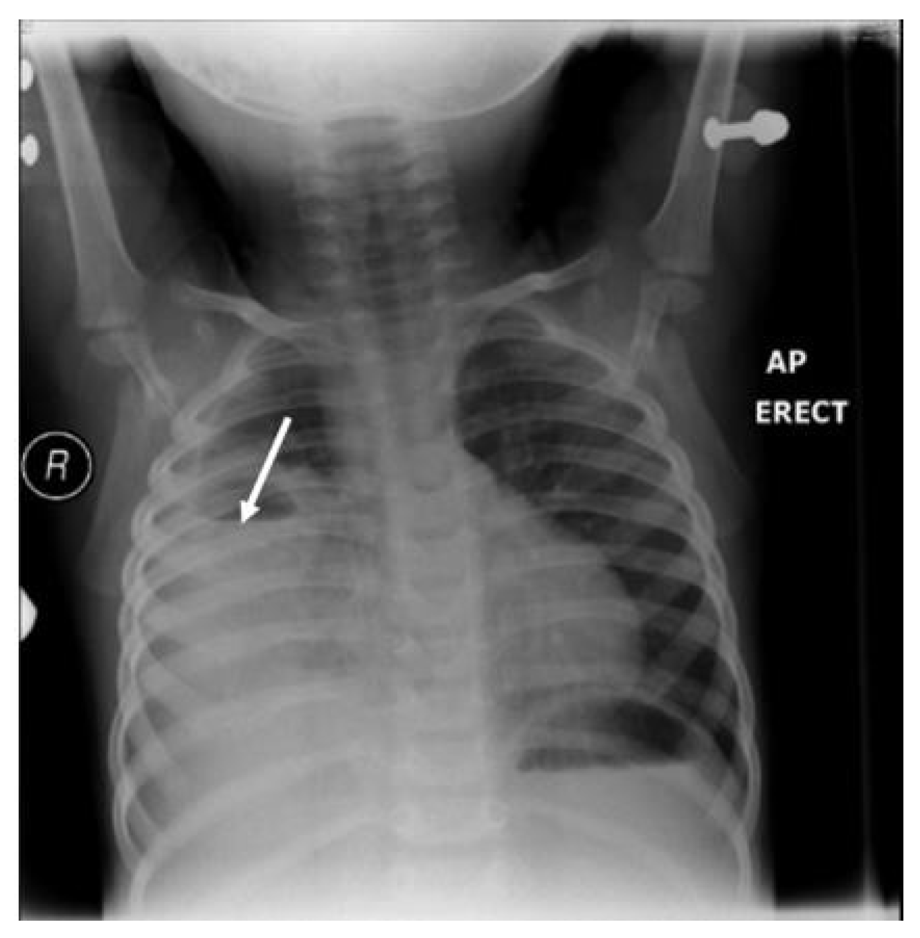 Children | Free Full-Text | Lung Abscess Case Series and Review of the  Literature
