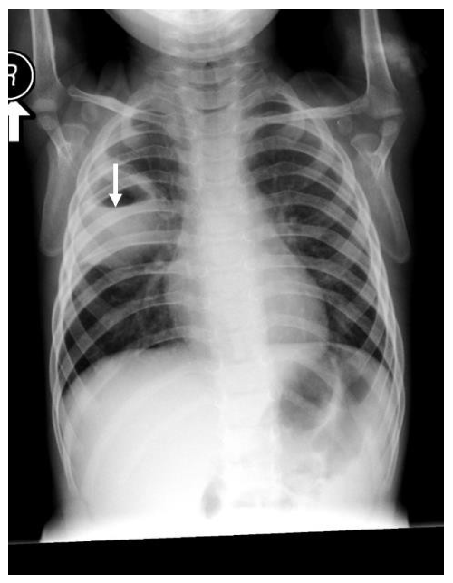 Children | Free Full-Text | Lung Abscess Case Series and Review of the  Literature