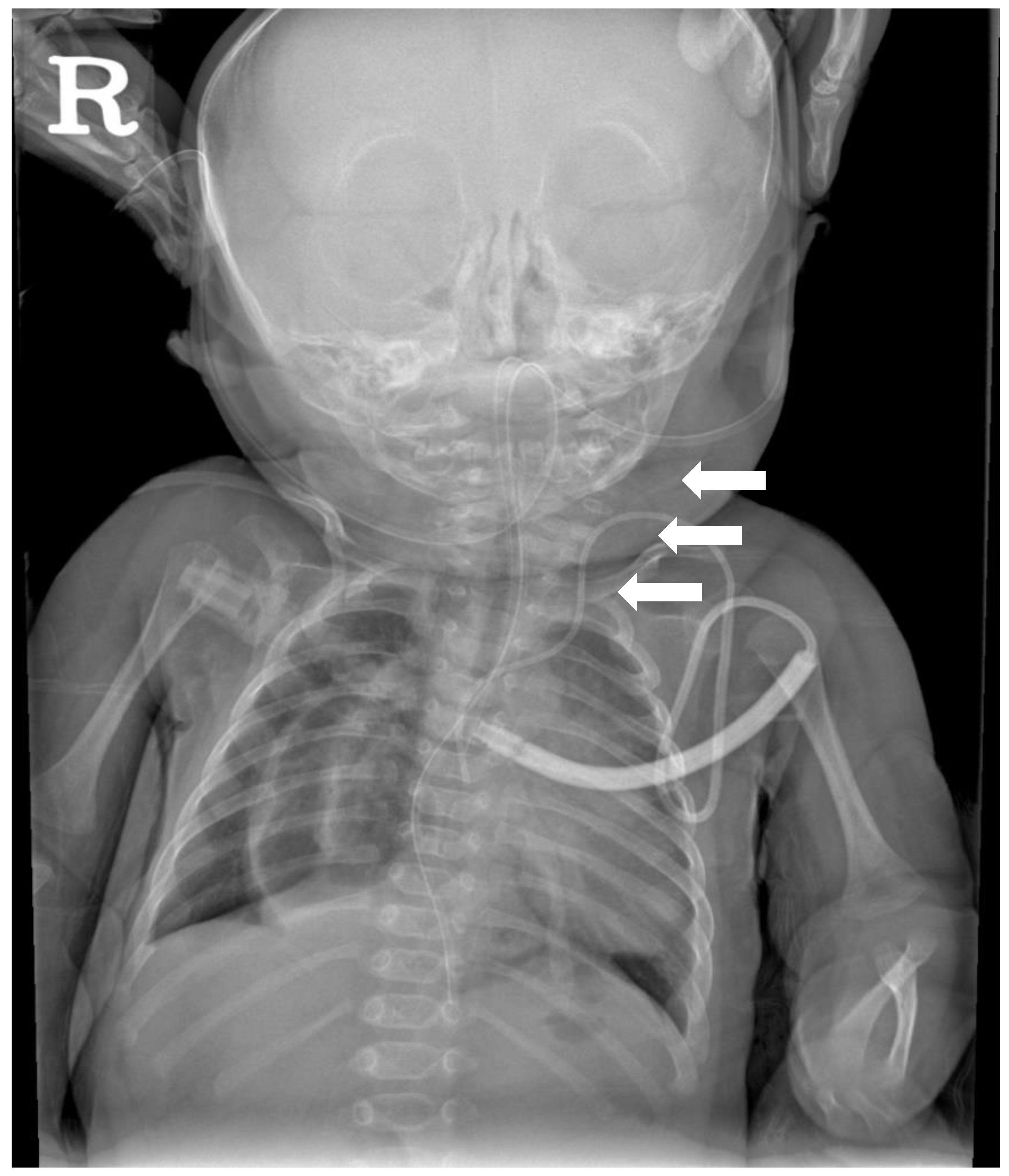 Children Free Full-Text An Unusual Case of Torticollis Split Cord Malformation with Vertebral Fusion Anomaly A Case Report and a Review of the Literature