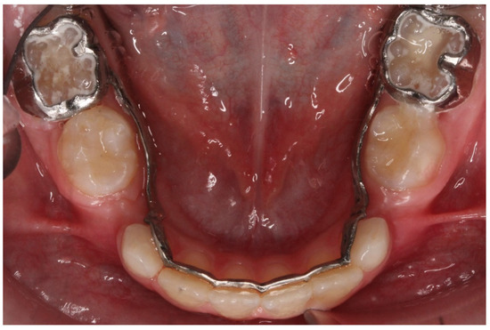 Three-Dimensional-Printed Customized Orthodontic and Pedodontic ...