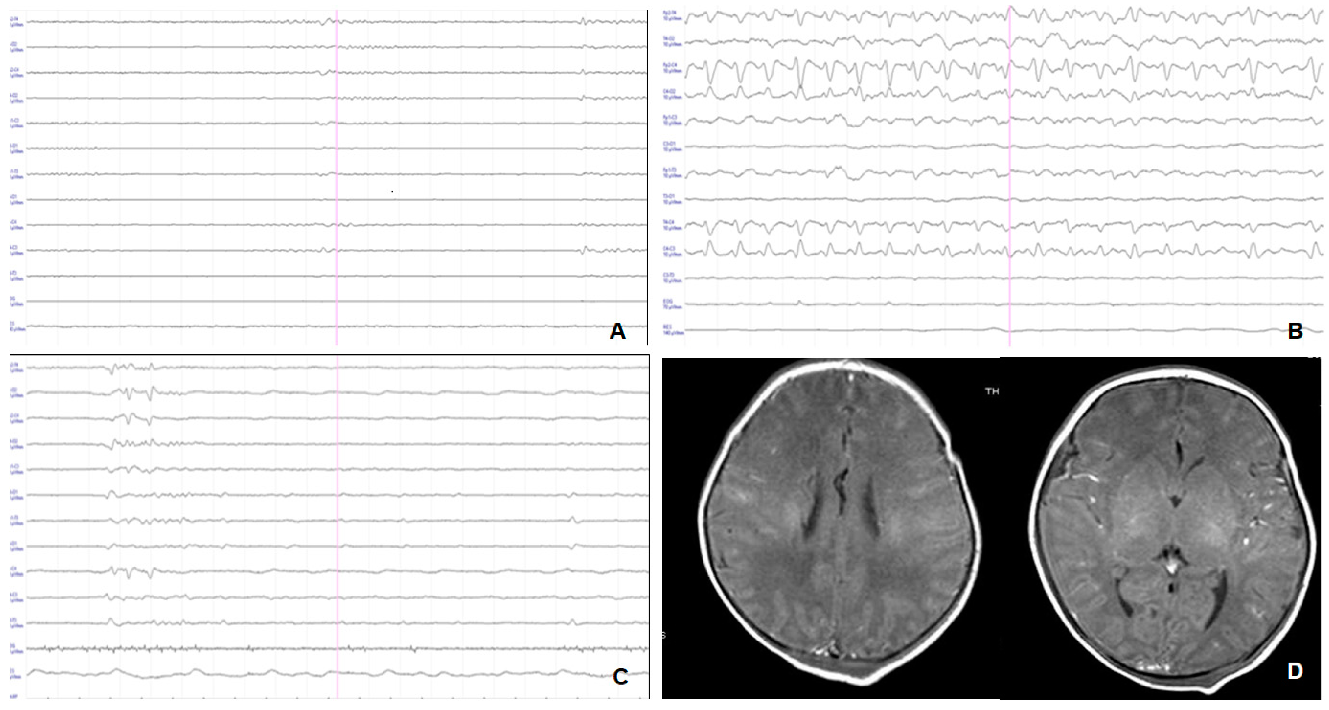 Urgent: Understanding The Significance Of Xl Spikes In Eeg Readings - doog576
