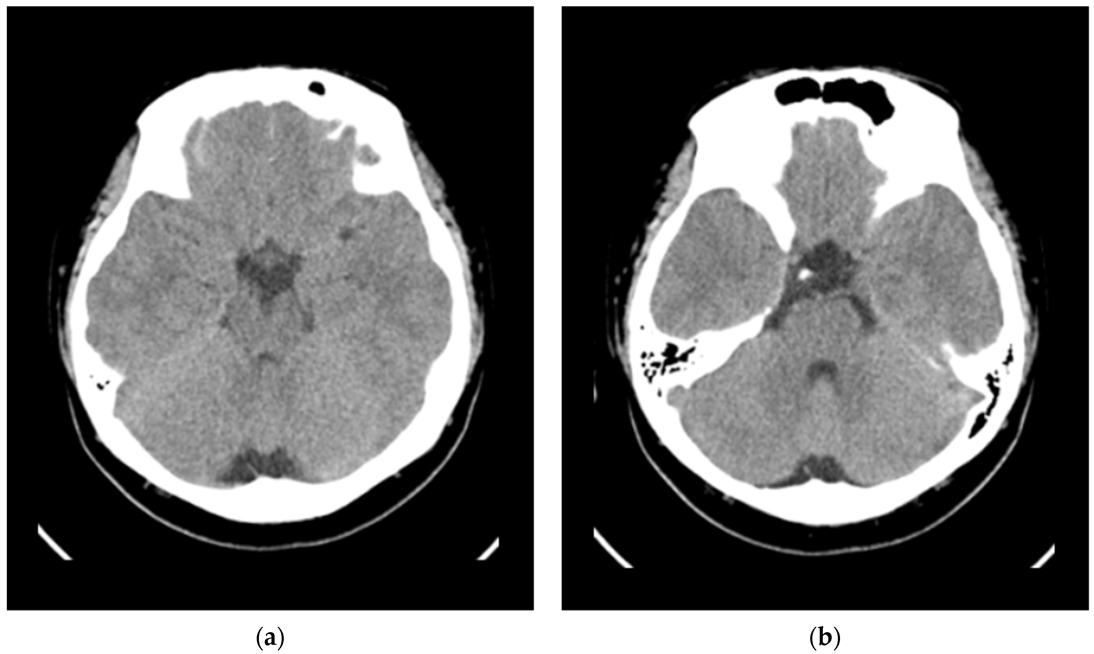 Adrenal Crisis Mimicking COVID-19 Encephalopathy in a