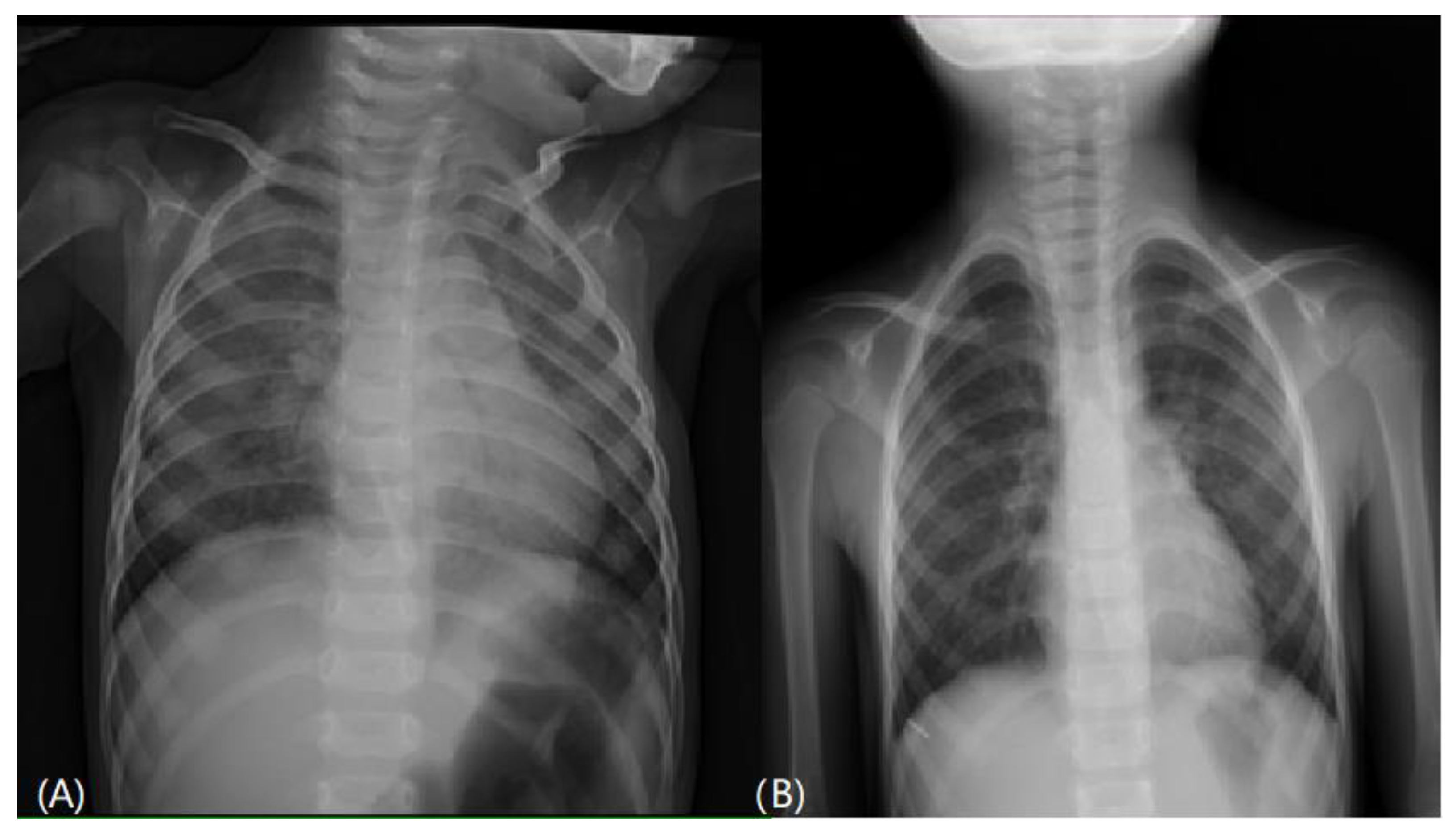Children Free FullText Congenital Surfactant C Deficiency with
