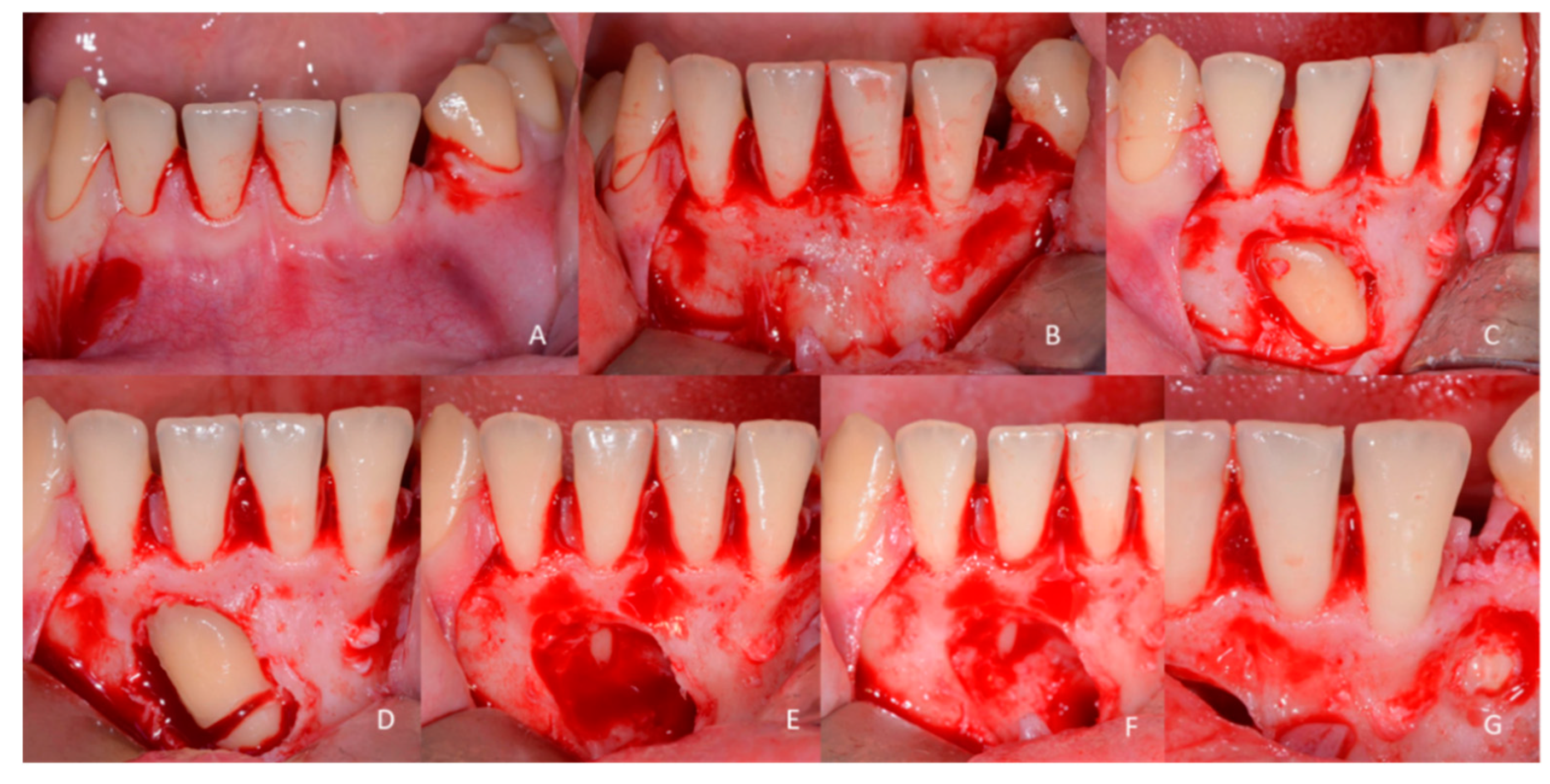 Children | Free Full-Text | Characteristics, Diagnosis and Treatment of Compound  Odontoma Associated with Impacted Teeth