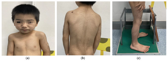 Clinical and molecular findings of the six patients with Rubinstein