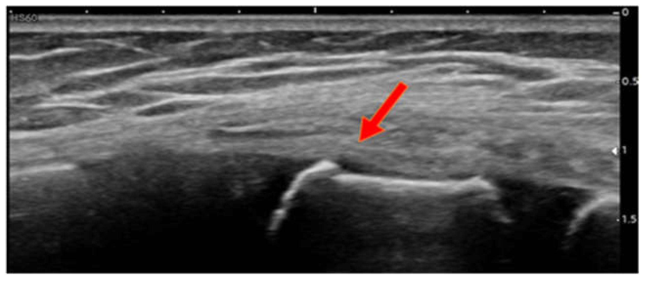 Children Free FullText POCUS Diagnosis of Sternal Fractures in